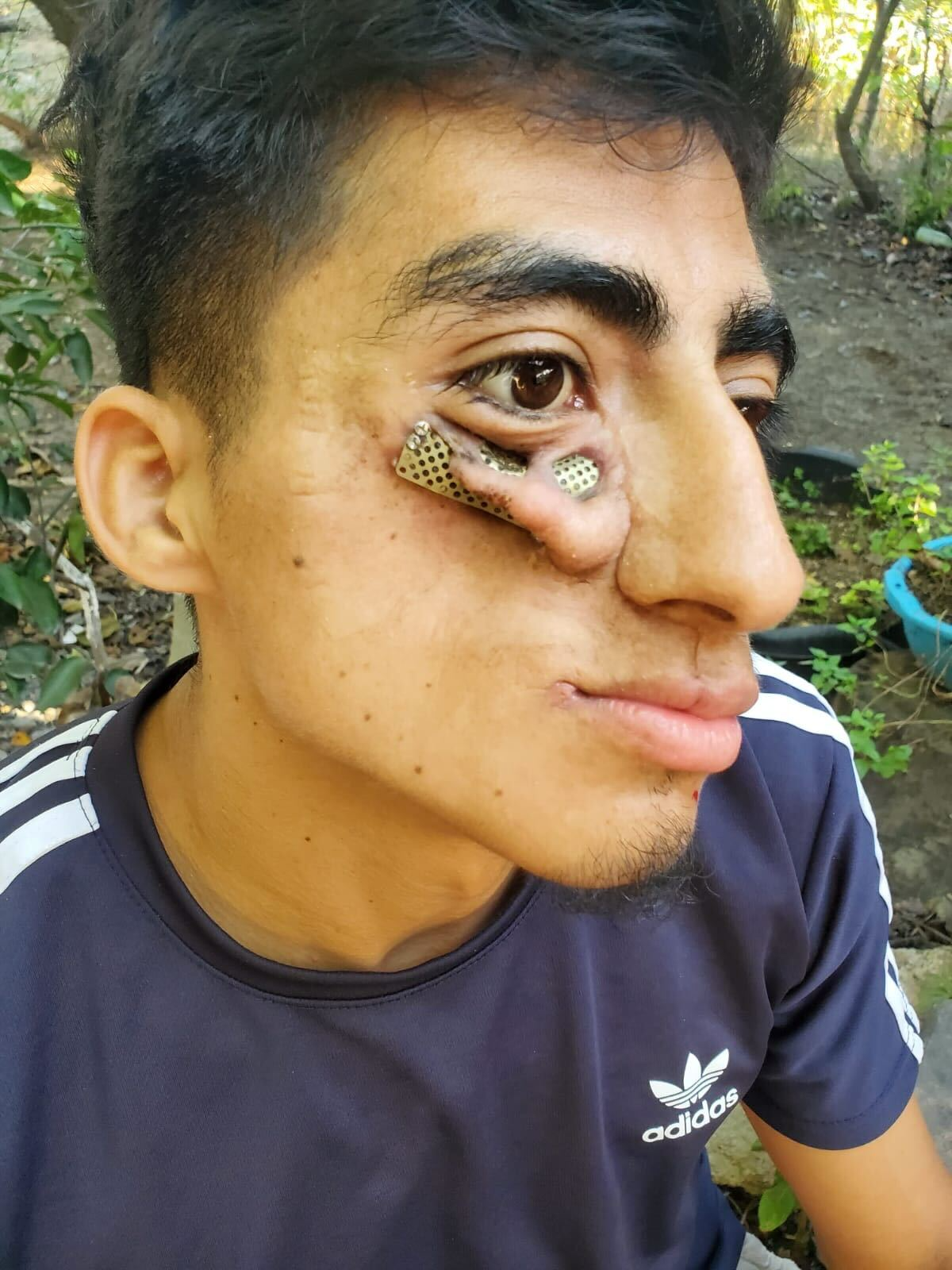 Facial Reconstruction Case