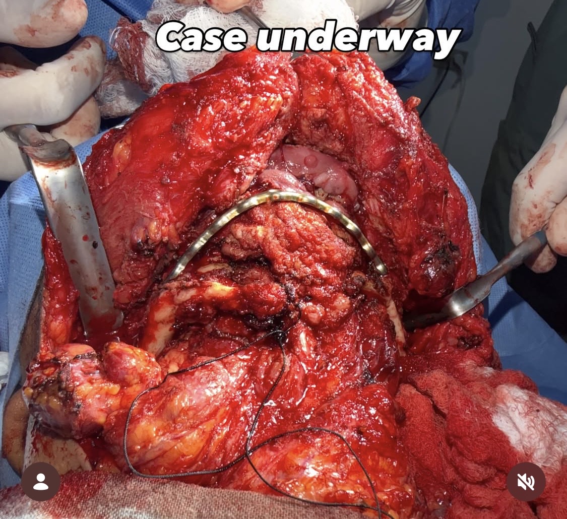 Intra-operative view of mandible reconstruction with a reconstruction plate in place — case underway in Guatemala