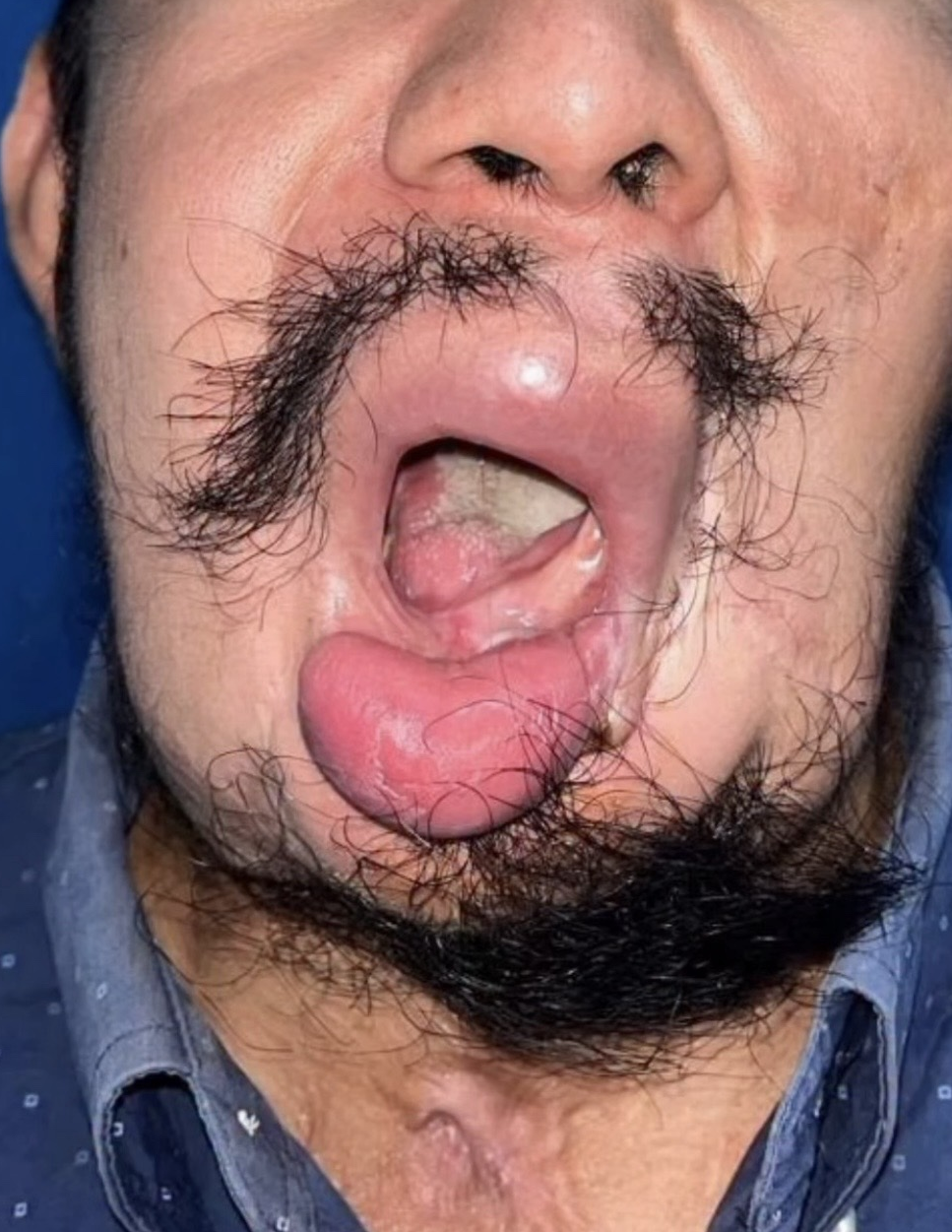 Path case coming up in Guatemala. Old GSW going to be treated with staged bone and soft-tissue reconstruction — hardware removal, mandible repositioning, and right fibula free flap.
